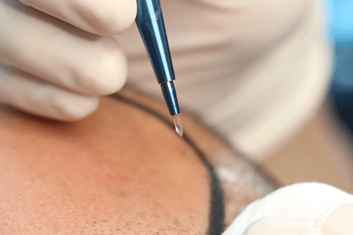 زراعة الشعر بتقنية Sapphire FUE