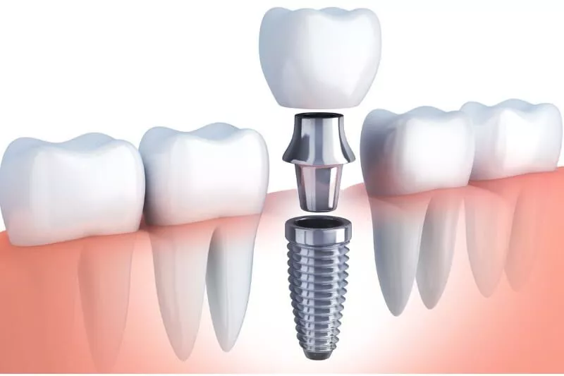 Implants dentaires premium